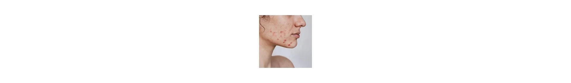 Soin Peau Acne - Parapharmacie en Ligne en Tunisie - Para Fendri
